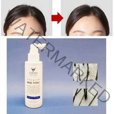 두피 가려움 열 감 정수리 머리 냄새 제거 영양제 스프레이 보습제 미스트 헤어토닉 도포기