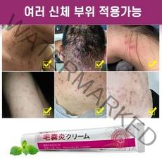 피부가려움증 모낭염 연고 지루성피부염 건선연고 여드름 습진 크림, 3개, 20g